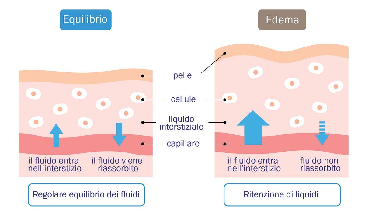 Ritenzione di liquidi